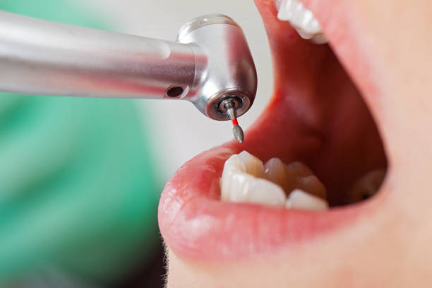 Best Emergency Dental Extractions in Murphy, MO